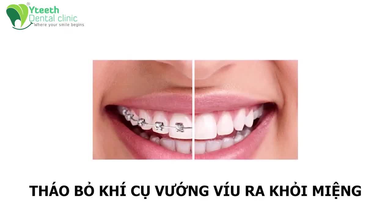 Nghe CHUYÊN GIA CHỈNH NHA hướng dẫn cách CHĂM SÓC RĂNG SAU THÁO NIỀNG