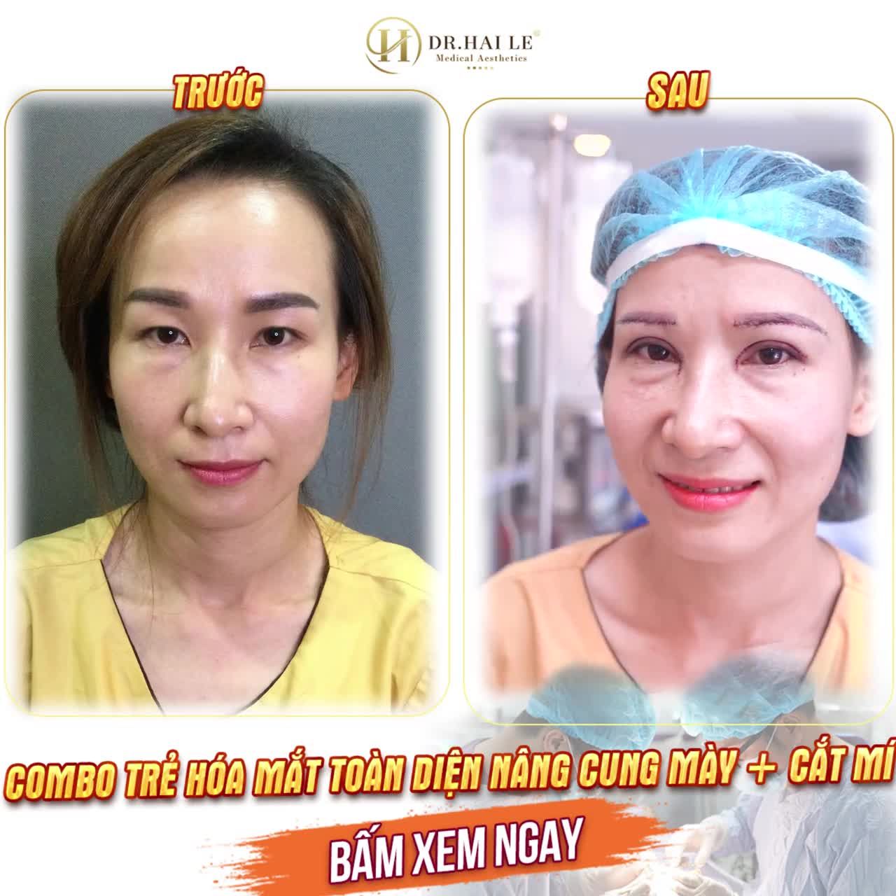 Người thật việc thật: Gói trẻ hóa toàn diện mắt combo Nâng cung mày + Cắt mí Dr.Hải Lê chưa bao giờ làm bạn thất vọng!!