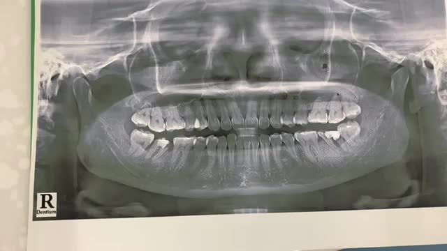 Nhổ răng 37 bị hỏng, gây đau nhức cho chị khách hàng tại Nha Khoa Thuỳ Anh.