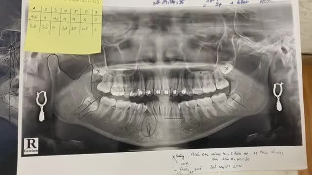Nhổ răng 5 hàm nhỏ phục vụ chỉnh nha tại Nha Khoa Thuỳ Anh.