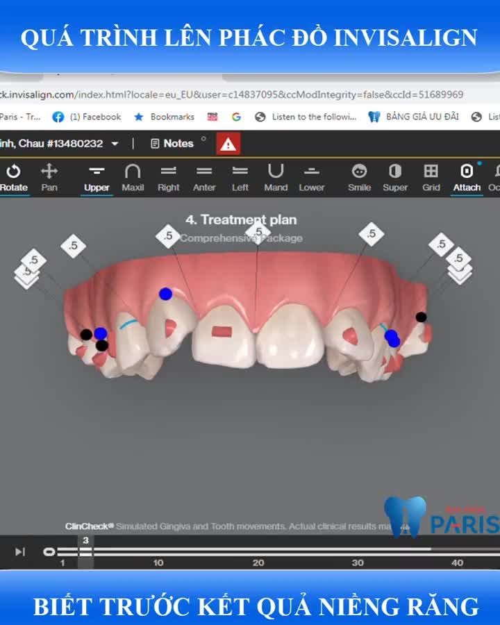 NIỀNG RĂNG INVISALIGN - DÁM "ĐƯƠNG ĐẦU" VỚI CA RĂNG KHÓ