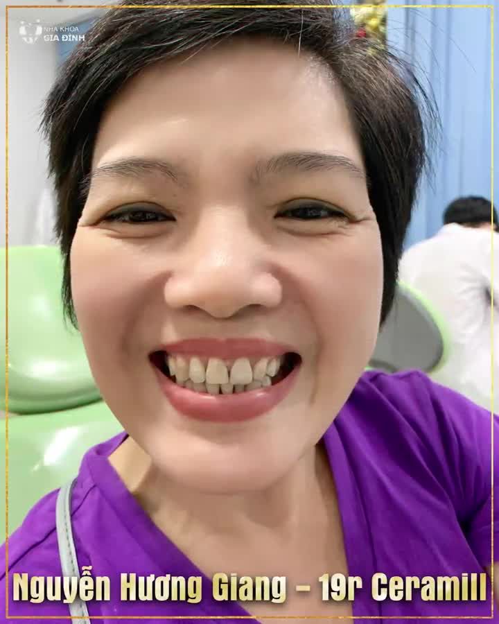 NỖI KHỔ CỦA CHỊ EM KHI PHẢI SỞ HỮU HÀM RĂNG NHIỄM MÀU KHÁNG SINH