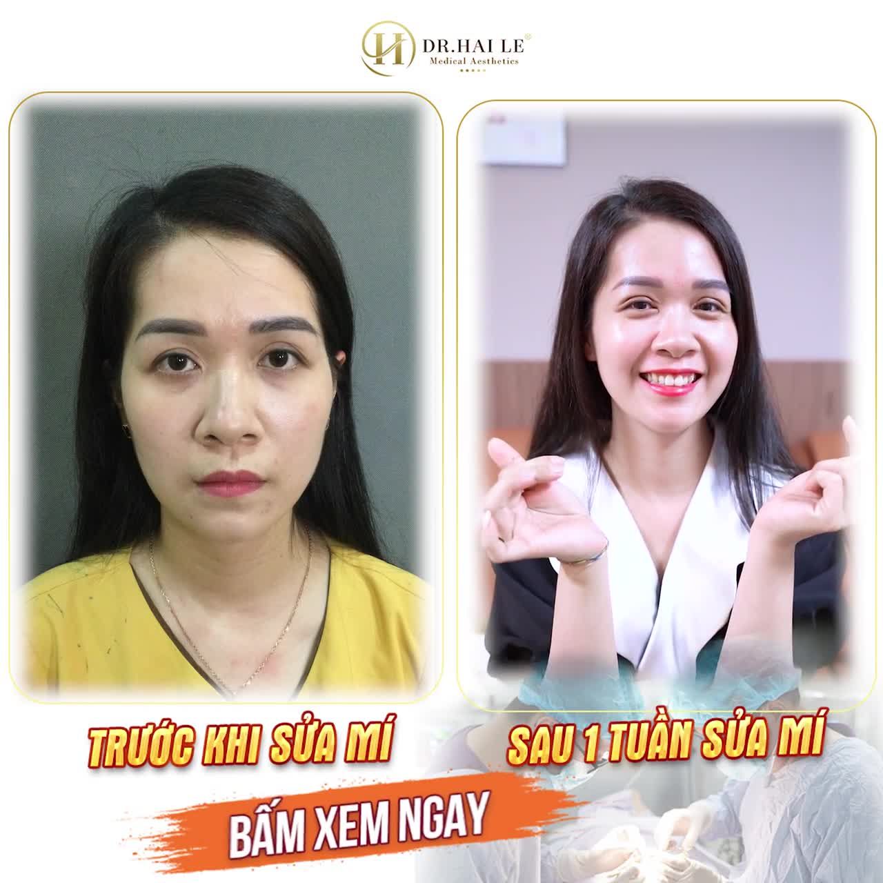 Nụ cười tươi rói của khách hàng nhà Dr.Hải Lê sau 7 ngày sửa mí.