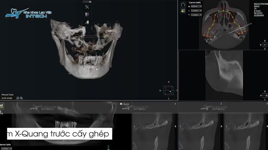PHÂN TÍCH LÂM SÀNG TRƯỜNG HỢP BỆNH NHÂN CẤY IMPLANT TOÀN 2 HÀM BẰNG PHƯƠNG PHÁP ALL - ON - 6