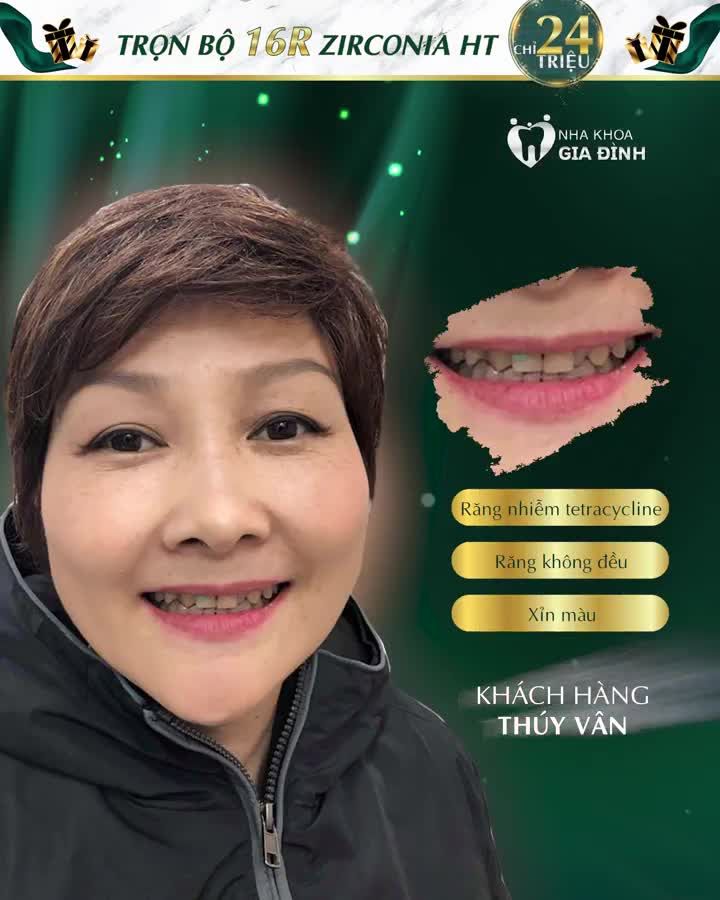 PHƯƠNG PHÁP LÀM ĐẸP RĂNG HOÀN HẢO NHẤT 2021 DÁN SỨ VENEER – BÍ QUYẾT CHO NỤ CƯỜI ĐẸP MÃI