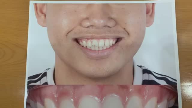 Quá trình mài tạo hình, làm răng sứ khắc phục tình trạng răng sứt mẻ cho khách hàng tại Nha Khoa Thùy Anh.