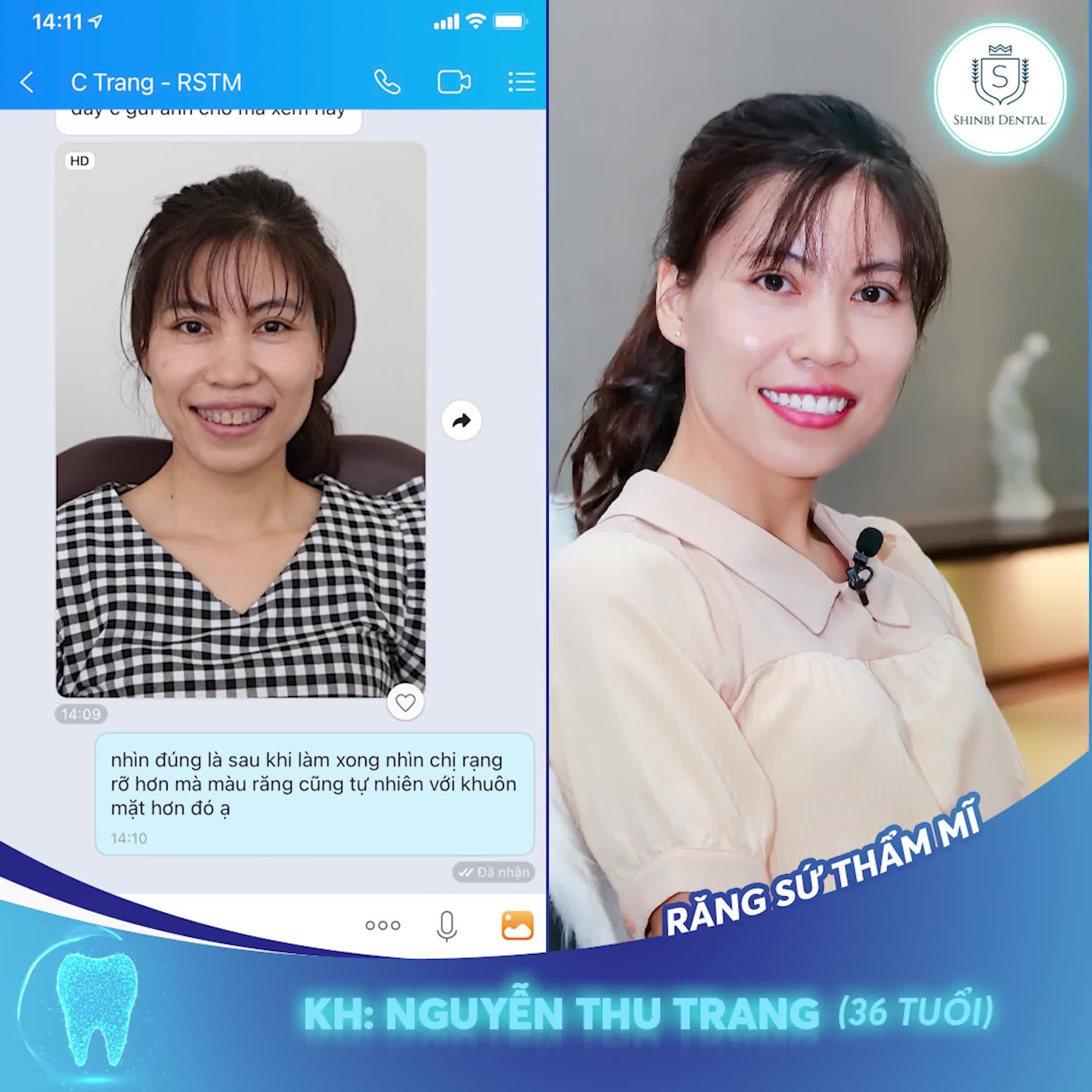 Rạng rỡ, tự tin như chị Thu Trang sau khi bọc răng sứ