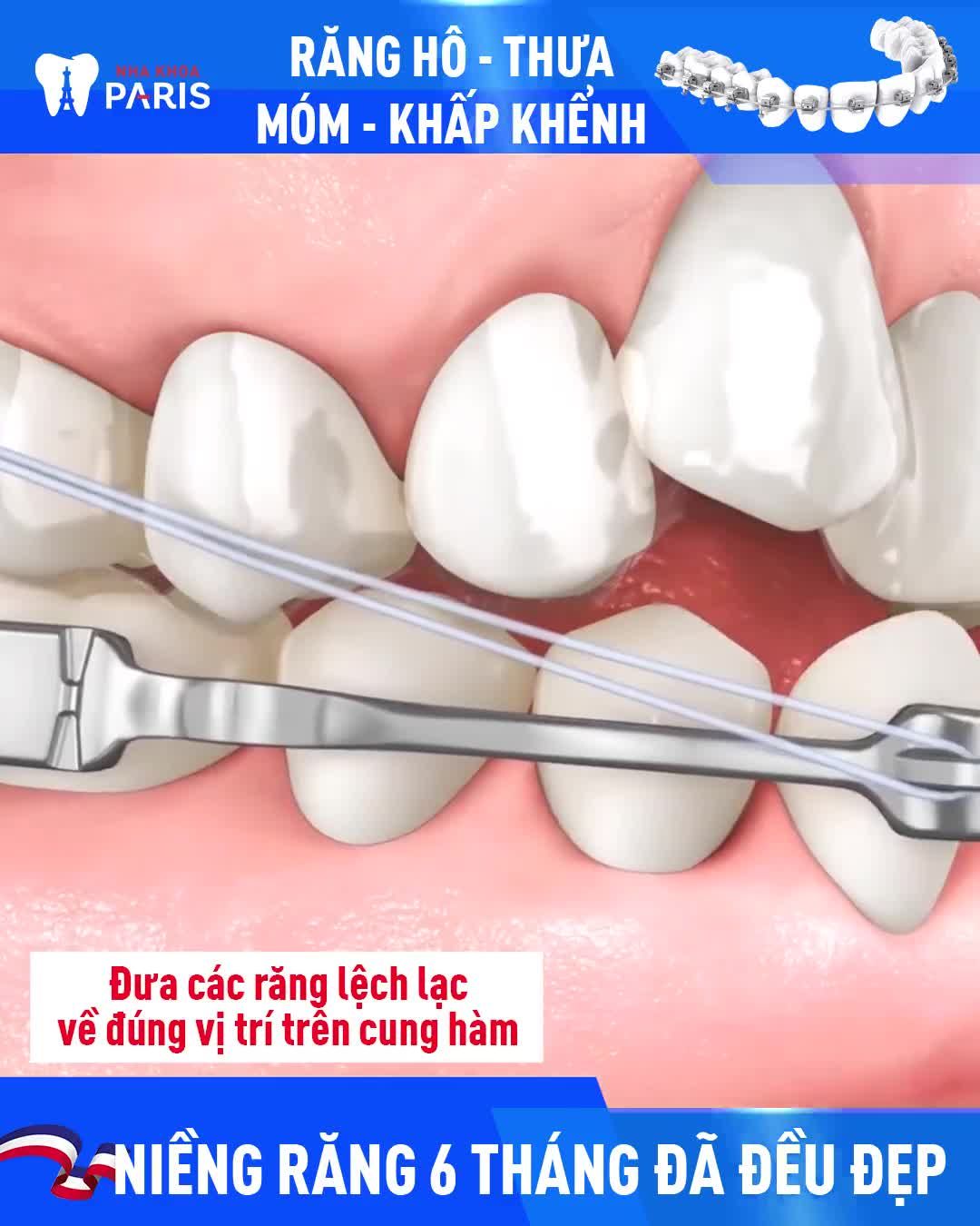 RĂNG THƯA, HÔ, MÓM, MỌC LỆCH