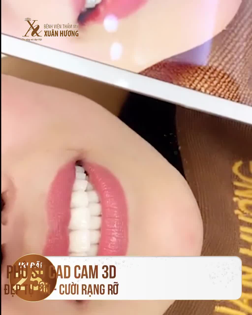 RĂNG THƯA Ố VÀNG ĐƯỢC PHỦ SỨ TOÀN DIỆN