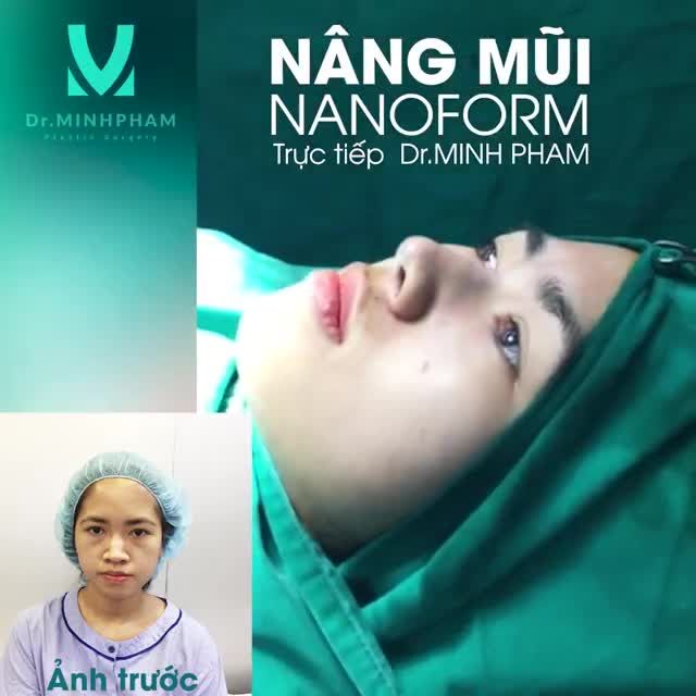 Review lại cho chị em ca mũi đẹp suất xắc của Dr. Minh Pham gần đây nhất nhé
