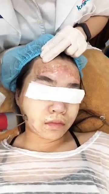 SẸO BỎNG NẶNG trên khuôn mặt - Xử lý như thế nào?