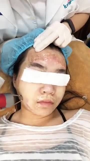 SẸO BỎNG NẶNG trên khuôn mặt - Xử lý như thế nào?