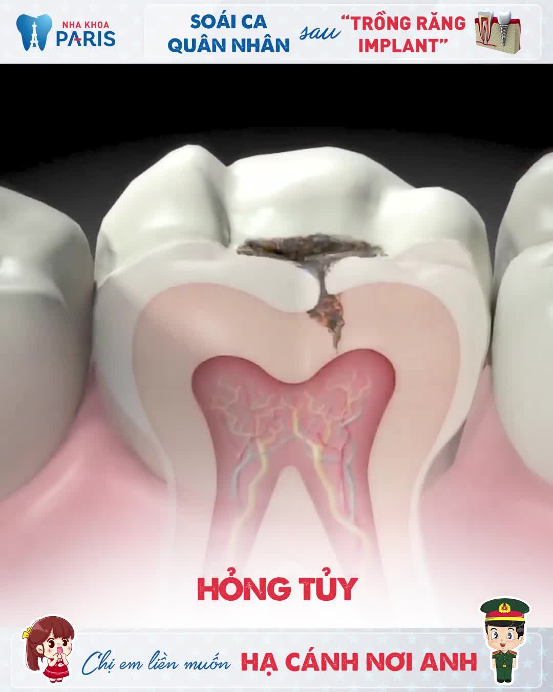 SOÁI CA TRỒNG RĂNG KHIẾN CHỊ EM MUỐN HẠ CÁNH NƠI ANH