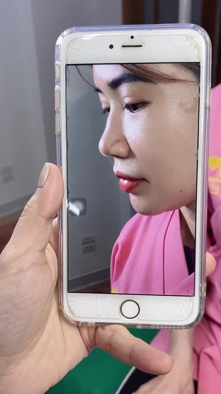 Sống mũi thấp, gồ được các bác sĩ biến hình thành mũi cao, thẳng, hút mắt.