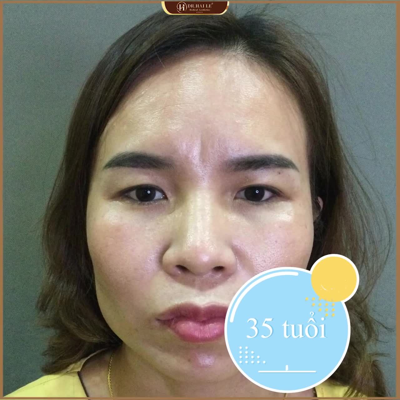 Sự KHÁC BIỆT giữa phụ nữ độ tuổi 35-45 trước và sau khi nâng cung mày