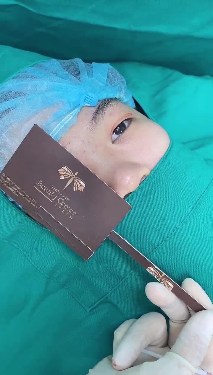 Sự khác biệt rõ rệt trước và sau khi Cắt mí- Bóc mỡ mắt của bạn khách hàng. Vừa làm xong mắt đã đẹp hơn và thay đổi hoàn toàn so với trước làm.