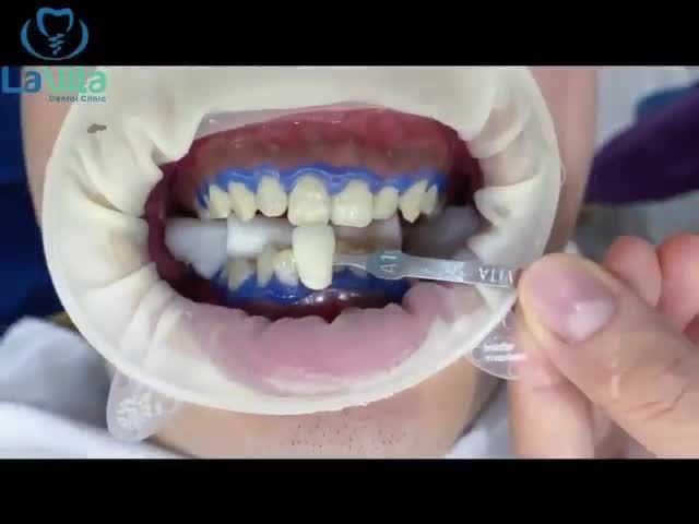 TẠI SAO BẠN NÊN LỰA CHỌN TẨY TRẮNG RĂNG TẠI NHA KHOA LAVITA?