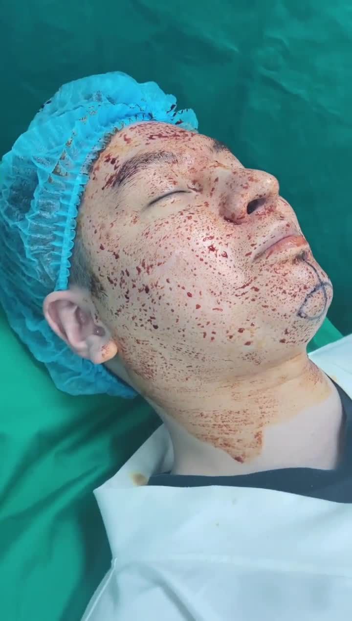 Tạm biệt cằm ngắn lẹm vĩnh viễn với 1h phẫu thuật độn cằm cùng bác sĩ của Tấm.