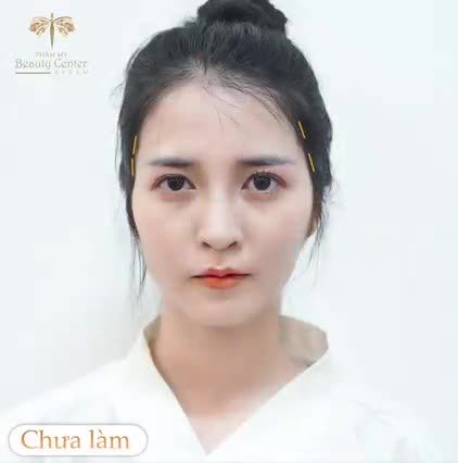 Trả lại nét xuân thì- ĐẸP TỰ NHIÊN nhưng không tự nhiên mà đẹp. Bí kíp chính là Filler đầy hóp má, thái dương tại Tấm.