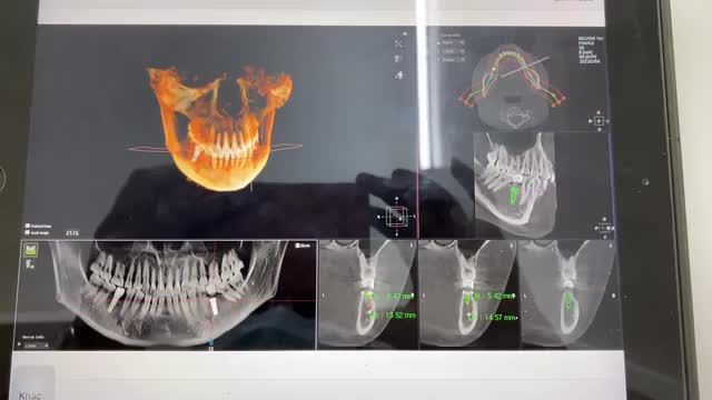 Trồng răng 36 implant  cho khách hàng tại Nha Khoa Thuỳ Anh.