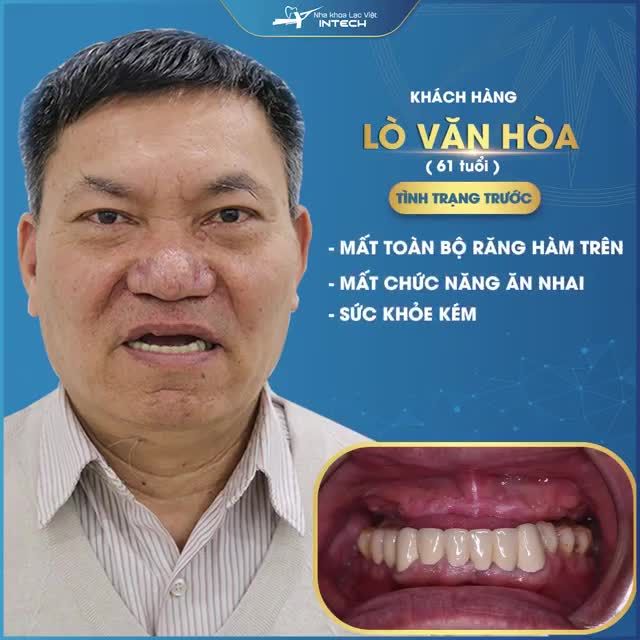 TRỒNG RĂNG IMPLANT ALL-ON-4 - GIẢI PHÁP CHO NGƯỜI MẤT RĂNG TOÀN HÀM