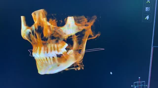 Trồng răng implant cho chị Ngân tại Nha Khoa Thuỳ Anh.