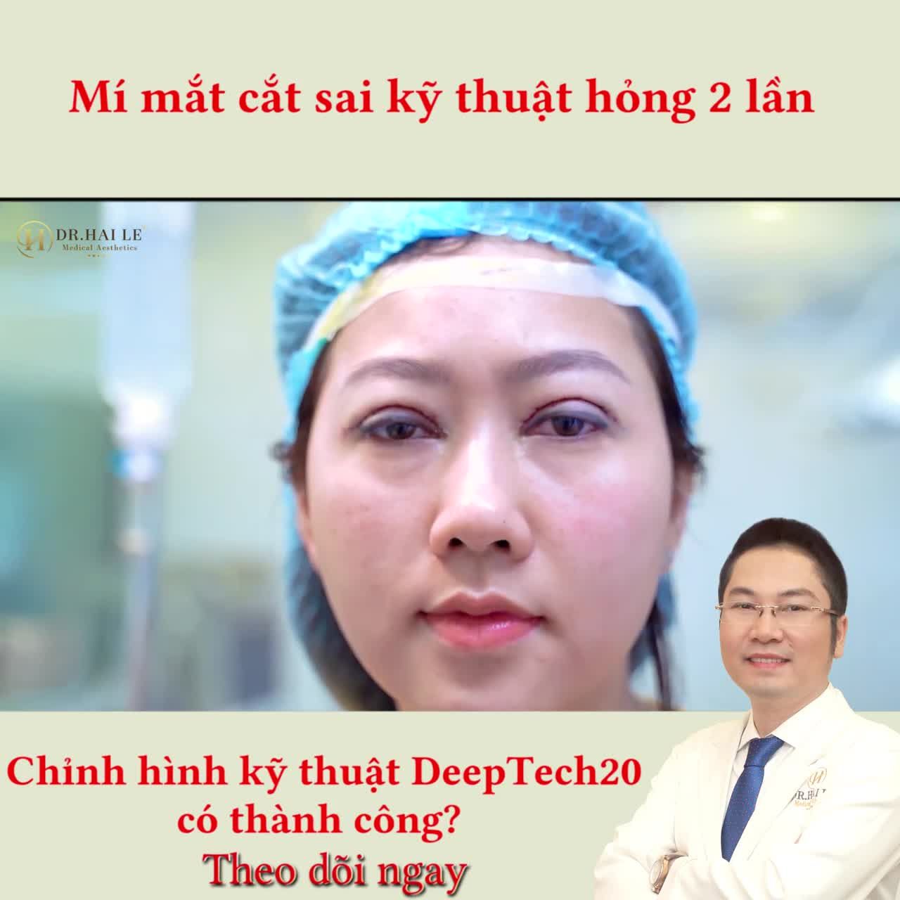 Từng cắt mí hỏng tới 2 lần tại cơ sở thẩm mỹ khác do thực hiện chưa đúng kỹ thuật