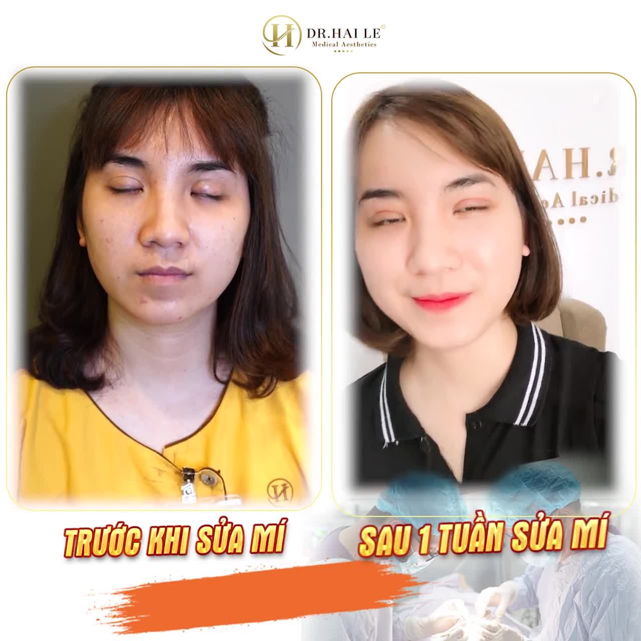 TUS DÀNH RIÊNG CHO KHÁCH HÀNG MÍ MẮT LỖI HỎNG