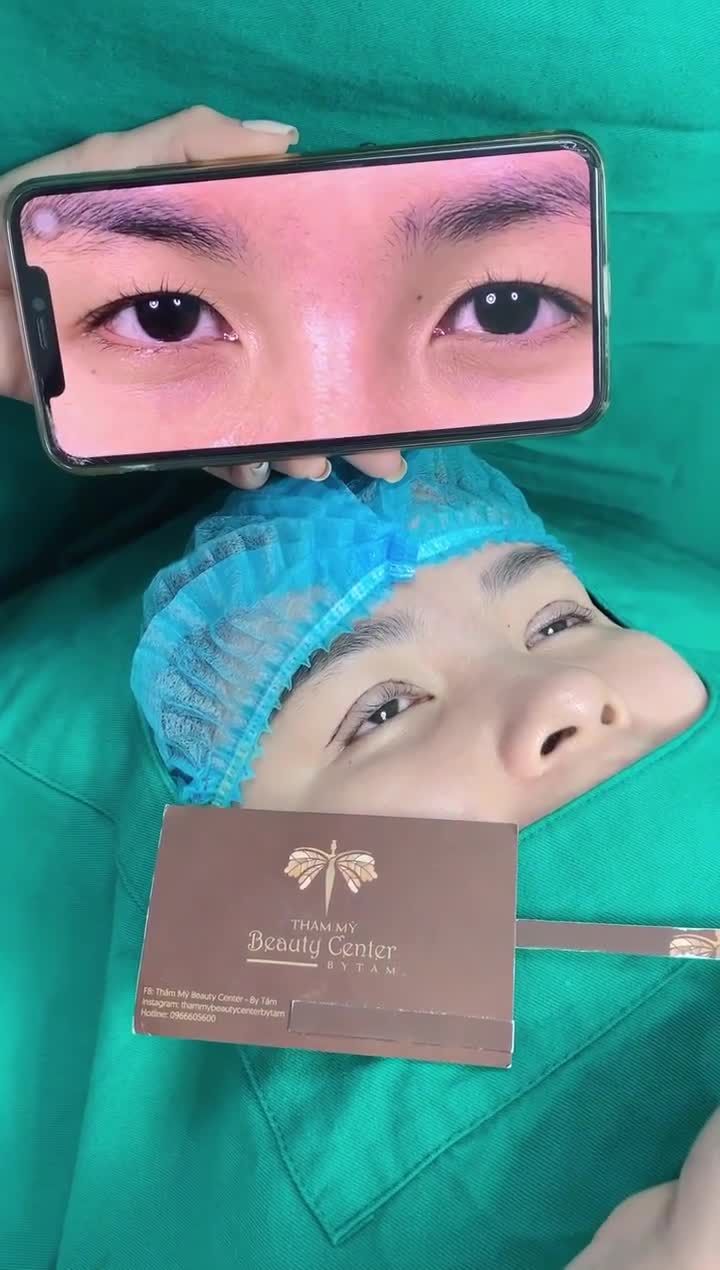 Vô tình xem Livestream cắt mí, mí đẹp theo cả đời.