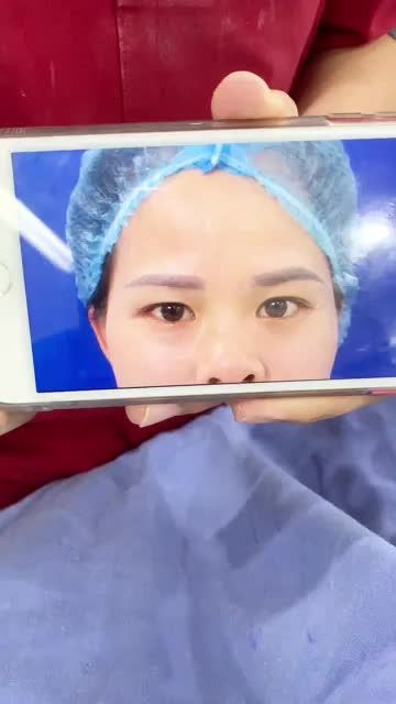 Vừa Cắt Mí + Lấy mỡ xong - BẤT NGỜ về kết quả