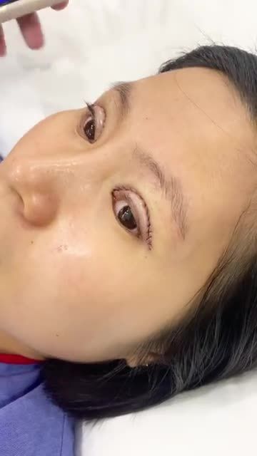 VỪA CẮT MÍ XONG SẼ NHƯ THẾ NÀO?