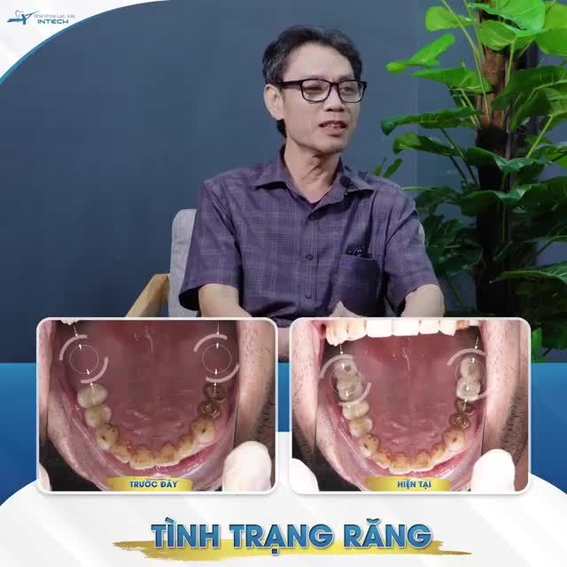 VỨT BỎ CẦU RĂNG SỨ CŨ, TRỒNG RĂNG IMPLANT THEO CÔNG NGHỆ MỚI HIỆU QUẢ RA SAO?