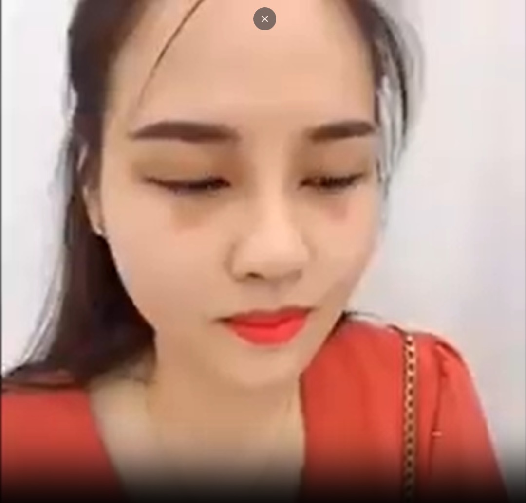 MŨI VÀ MÍ VỪA ĐƯỢC BÁC SỸ TRUNG VỪA LÀM XONG
