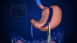 Video 3D mô phỏng PHẪU THUẬT NỘI SOI THU NHỎ DẠ DÀY HÌNH ỐNG điều trị thừa cân, béo phì