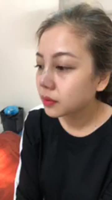 Ngay sau nâng mũi Sline bọc sụn tai!