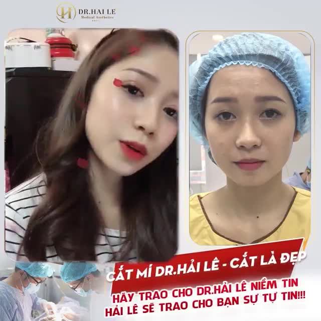 Cắt mí Dr.Hải Lê - Cắt là đẹp