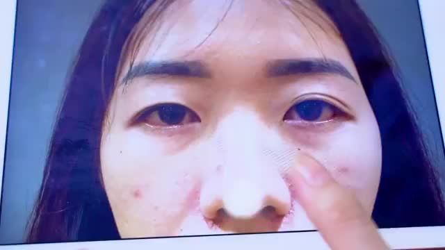 "Được biết Dr.Hải Lê top 1 cắt mí nên em đến trải nghiệm và thực sự trên cả sự mong đợi của em"