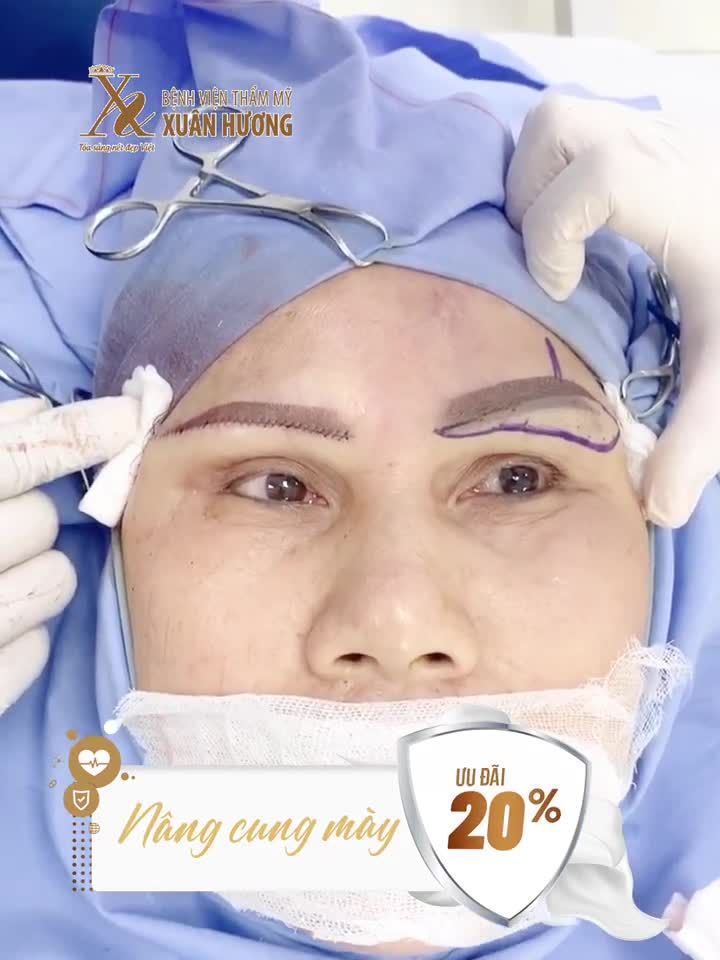 KẾT QUẢ KHÁC BIỆT SAU KHI NÂNG CUNG MÀY 1 BÊN VÀ SO SÁNH VỚI BÊN CÒN LẠI