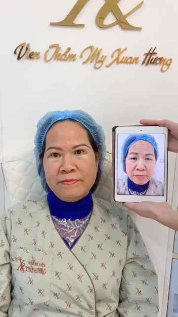 NỮ KHÁCH HÀNG U60 "HỒI XUÂN" CẢ CHỤC TUỔI SAU KHI THỰC HIỆN COMBO LÀM ĐẸP