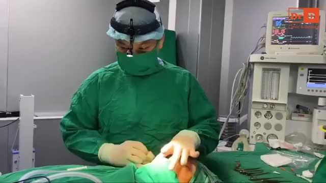 Bác sĩ phân tích tình trạng mũi trước của khách hàng: sống mũi thấp, da mũi mỏng, đầu mũi, cánh mũi to.