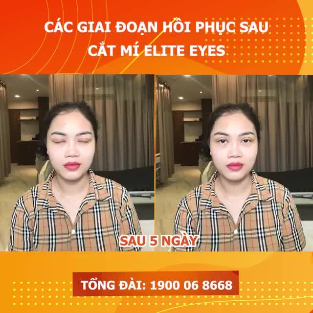 Cắt mí Elite Eyes bao lâu thì lành?