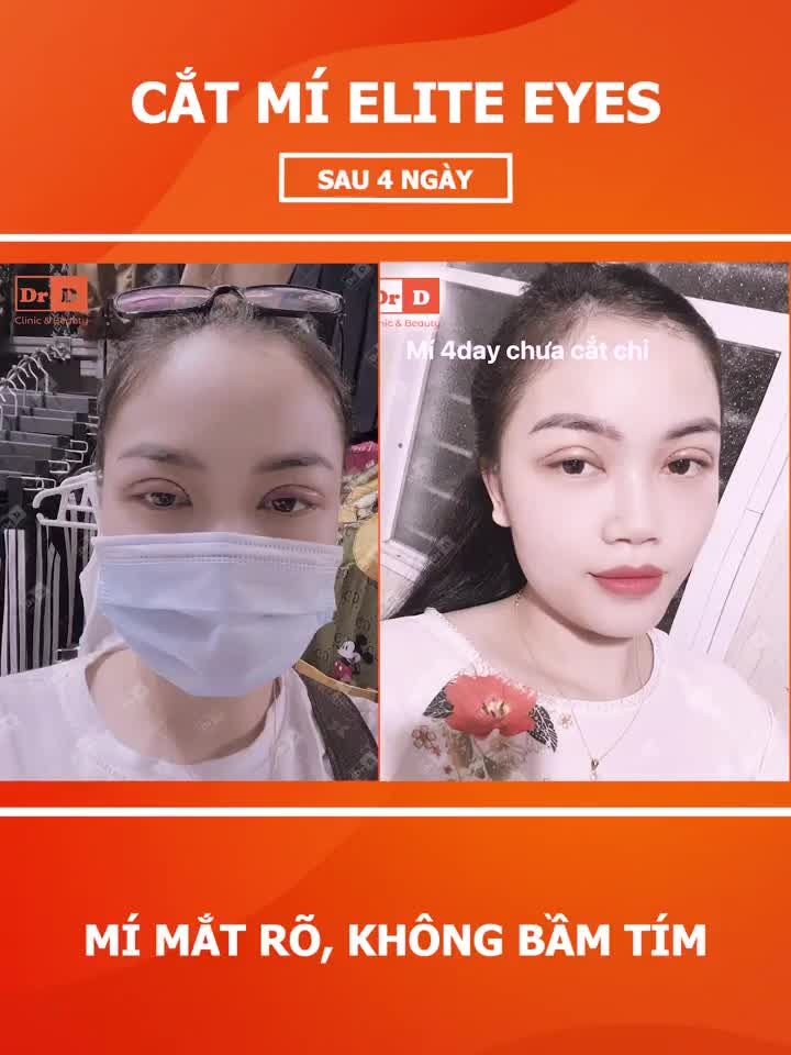 Cắt mí Elite Eyes - Đẹp tự nhiên, hài hòa gương mặt.