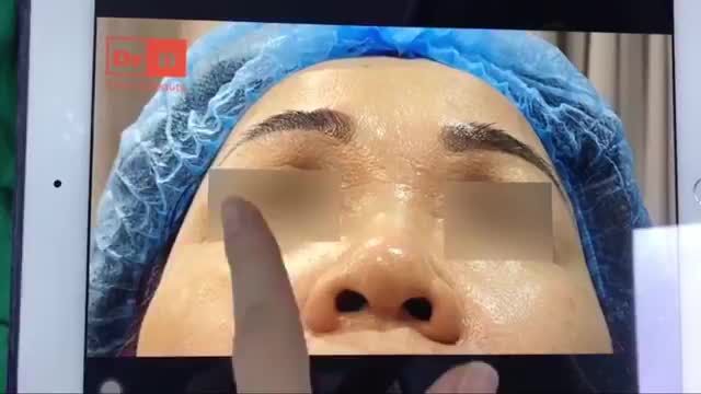 Chị khách hàng sống mũi thấp, đầu mũi to, thô, cánh mũi nở, khiến chị rất tự ti.