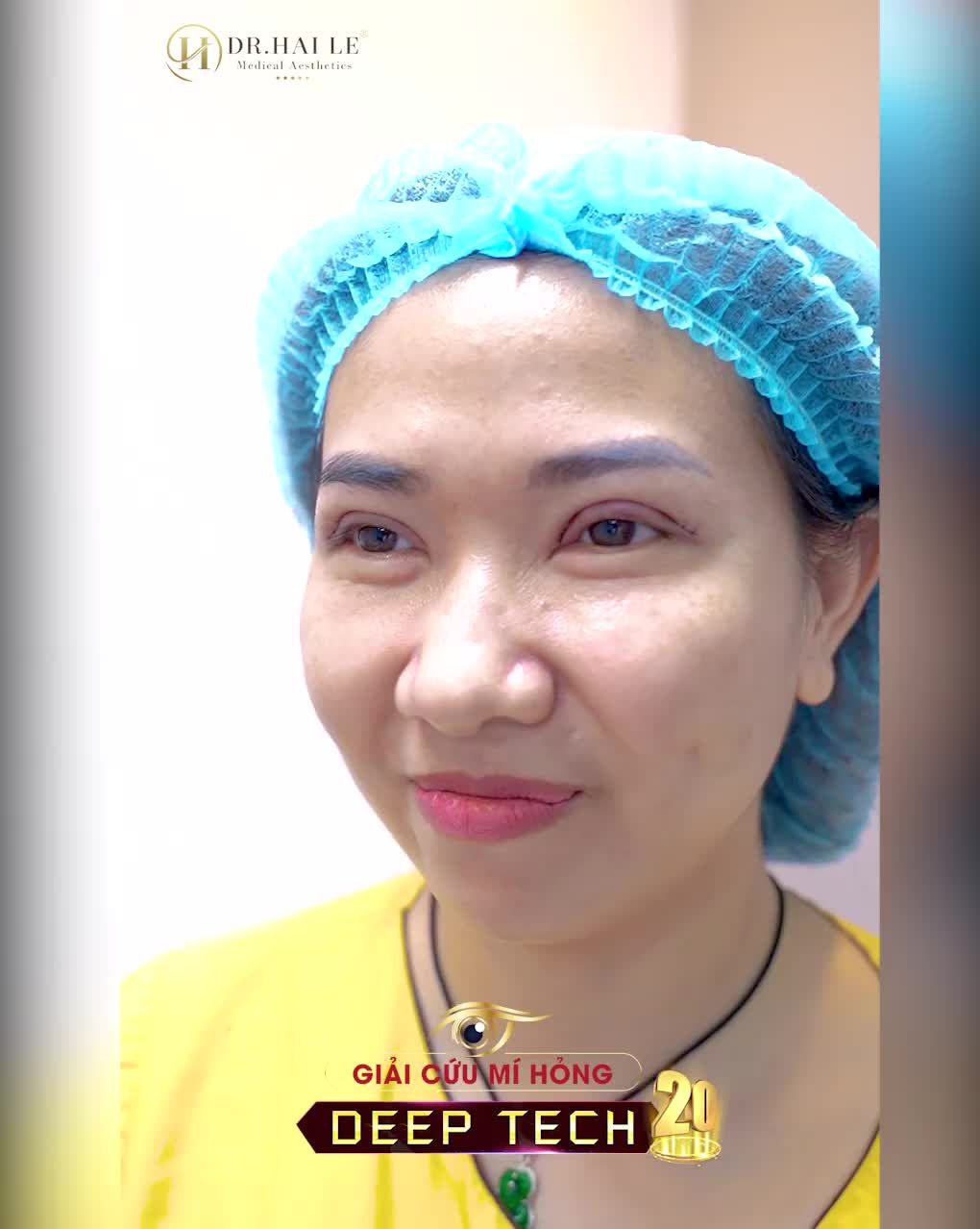 Hơn 1 năm sống trong mặc cảm, tự ti....Và quyết định tới Dr.Hải Lê sửa mí