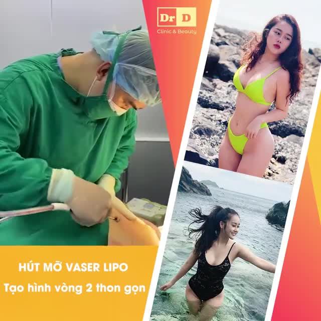 Hút mỡ Vaser Lipo - Tạo hình V2 thon gọn.