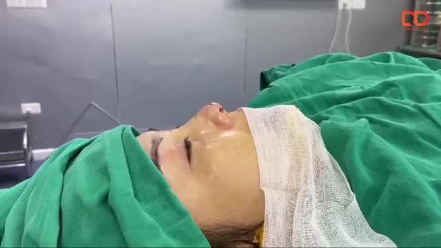 Khách hàng thực hiện nâng mũi, nâng cung mày kết hợp nâng ngực, treo sa trễ ngực.