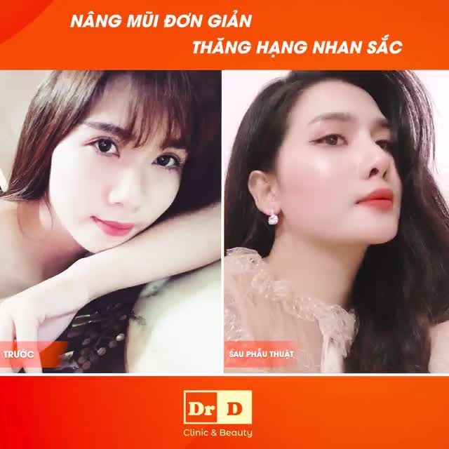 Nâng mũi đơn giản - Thăng hạng nhan sắc