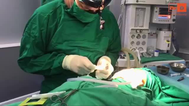 Nâng mũi - kết hợp chất liệu nhân tạo và sụn tự thân.