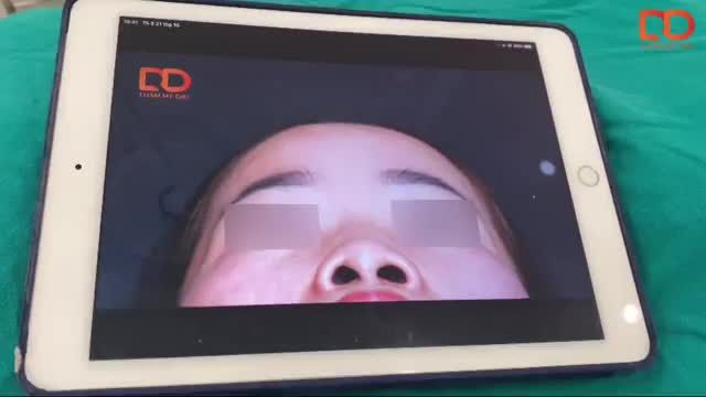 Nâng mũi Perfect Dform cải thiện tình trạng sống mũi thấp, xương mũi to, bè, mũi ngắn, đầu mũi hếch cho chị khách hàng thân thiết của Thẩm mỹ DrD.