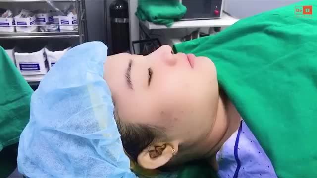 Nâng mũi Perfect Dform - Tạo dáng mũi siêu đẹp, đầu mũi "bay" sang chảnh, hiện đại.